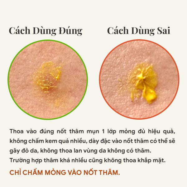 Opla kem chấm mờ thâm sau mụn